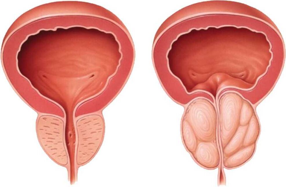 douleur à la prostate